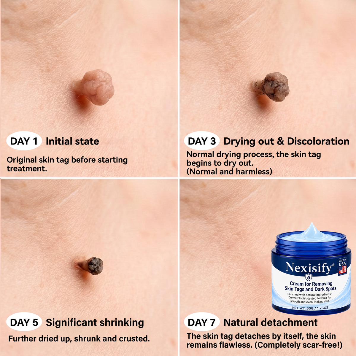 Nexisify® Advanced Correcting Cream for Skin Tags, Moles & Spots – 7‑Day Painless & Scar‑Free – Advanced Care for Skin Imperfections