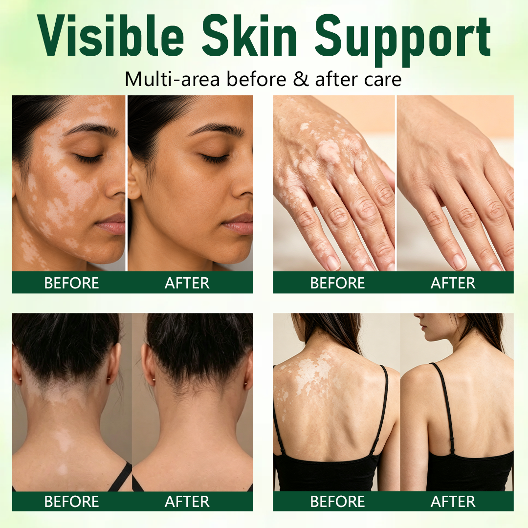 Herbal Vitiligo Cream&Bring Your Natural Skin Tone Back in 7 Days.