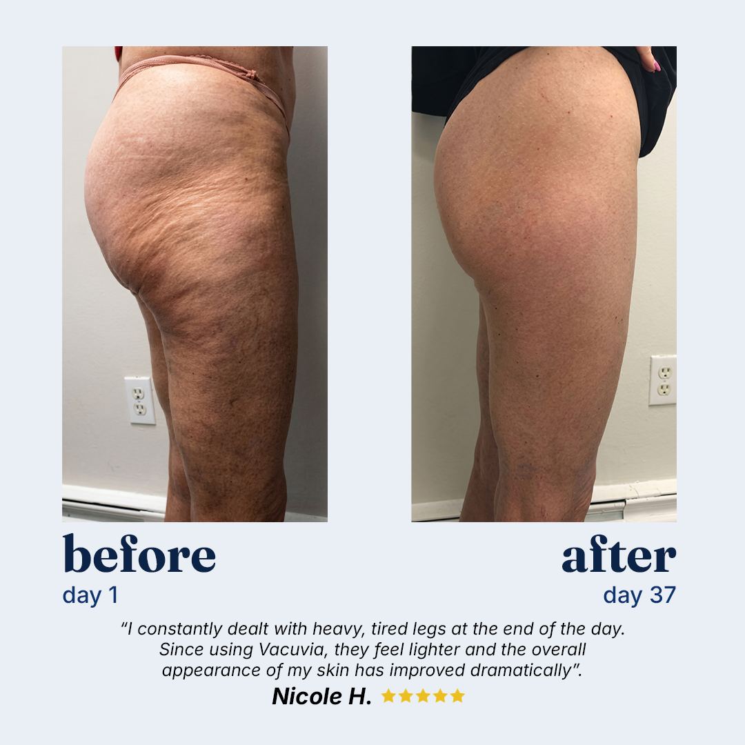 Vacuvia SculptGlow™ Firmer, More Toned Skin