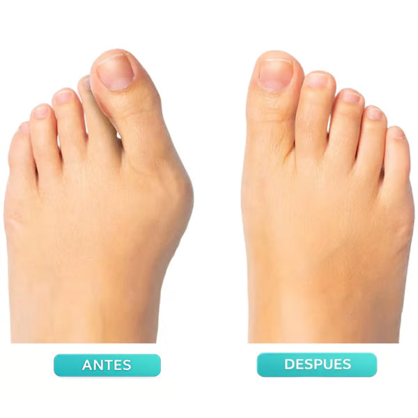 Father's Day Deal 👣Adjustable Bunion Corrector
