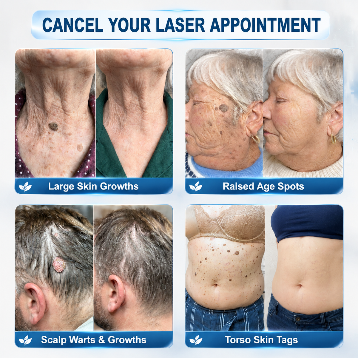 👩‍⚕️👪 𝐎𝐟𝐟𝐢𝐜𝐢𝐚𝐥 𝐒𝐭𝐨𝐫𝐞 | 𝑵𝐞𝒌𝐢𝐬𝐬® 🌿 𝐁𝐨𝐭𝐚𝐧𝐢𝐜𝐚𝐥 𝐌𝐢𝐜𝐫𝐨𝐧𝐞𝐞𝐝𝐥𝐞 𝐇𝐲𝐝𝐫𝐨𝐜𝐨𝐥𝐥𝐨𝐢𝐝 𝐏𝐚𝐭𝐜𝐡 (𝐅𝐨𝐫 𝐒𝐤𝐢𝐧 𝐓𝐚𝐠𝐬, 𝐒𝐦𝐚𝐥𝐥 𝐒𝐤𝐢𝐧 𝐆𝐫𝐨𝐰𝐭𝐡𝐬, 𝐖𝐚𝐫𝐭𝐬, 𝐌𝐨𝐥𝐞𝐬, 𝐀𝐠𝐞 𝐒𝐩𝐨𝐭𝐬 & 𝐏𝐢𝐠𝐦𝐞𝐧𝐭𝐚𝐭𝐢𝐨𝐧 𝐂𝐨𝐧𝐜𝐞𝐫𝐧𝐬)