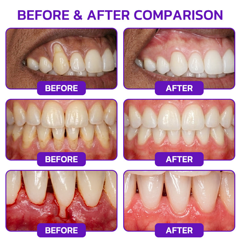 Bee poison Gingivitis & Periodontitis Treatment Toothpaste