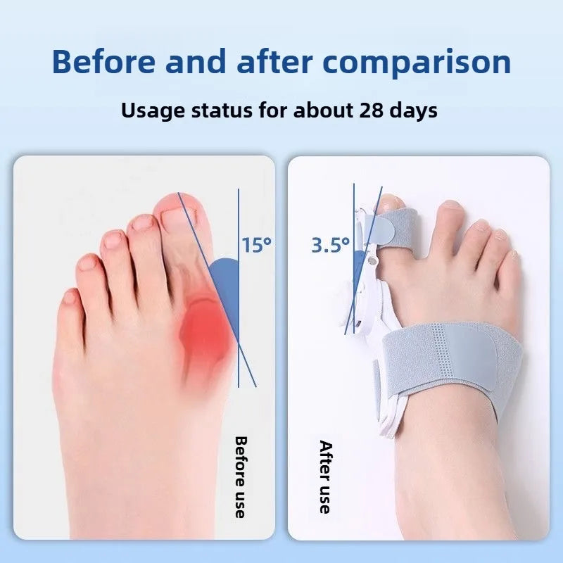 Bunion Corrector
