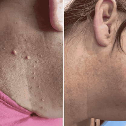 Painless Skin Tag Removal Kit