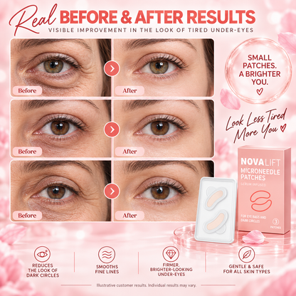 Micro Needle Eye Patches for Dark Circles & Wrinkles | Hyaluronic Acid Under Eye Treatment