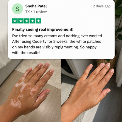 Herbal Vitiligo Cream&Bring Your Natural Skin Tone Back in 7 Days.