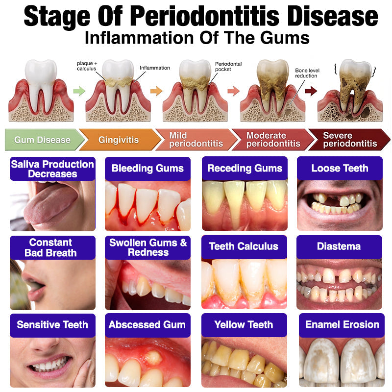 Bee poison Gingivitis & Periodontitis Treatment Toothpaste